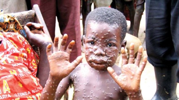 Cacar Monyet/Monkeypox